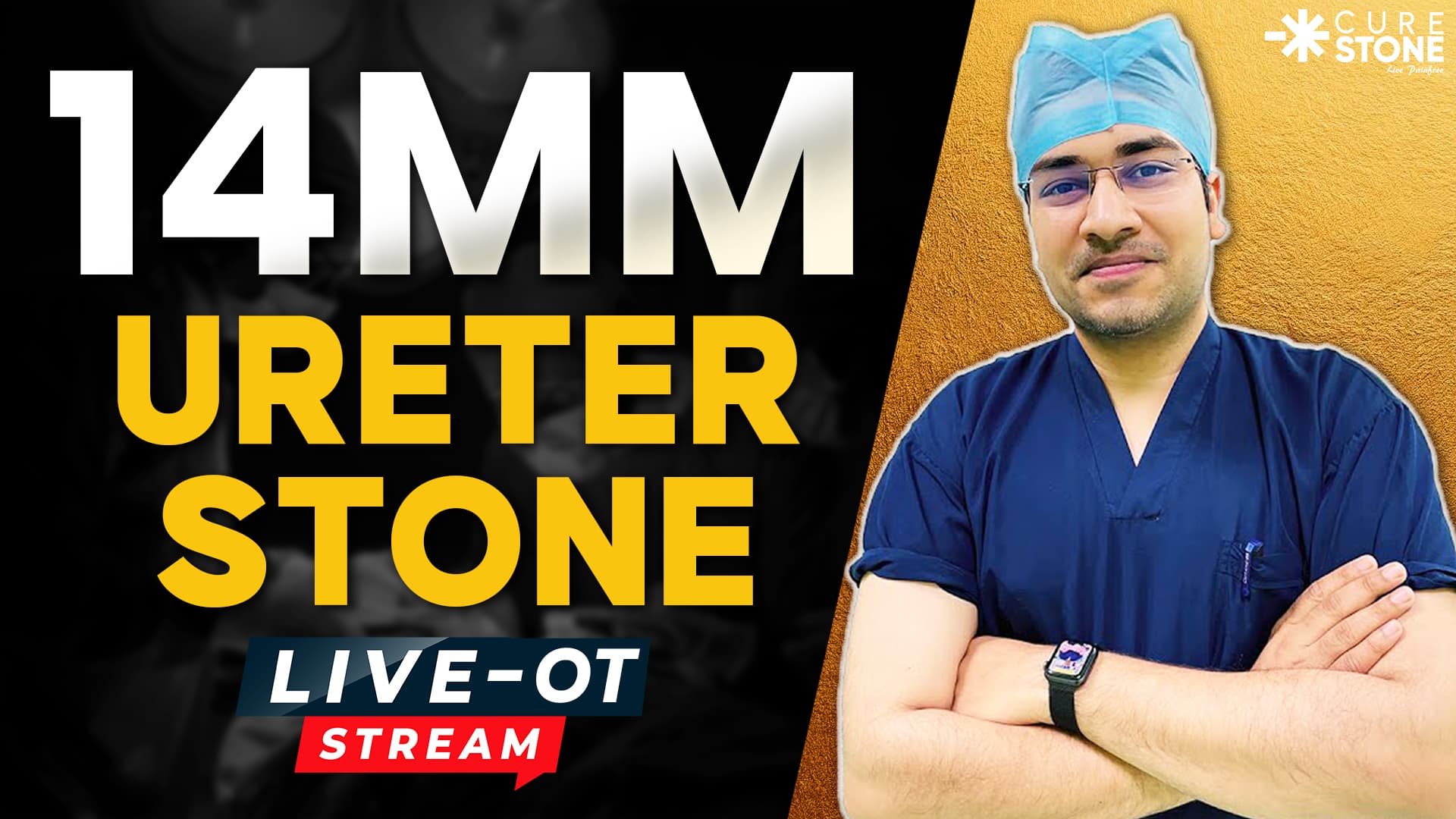 14mm Ureter Stone